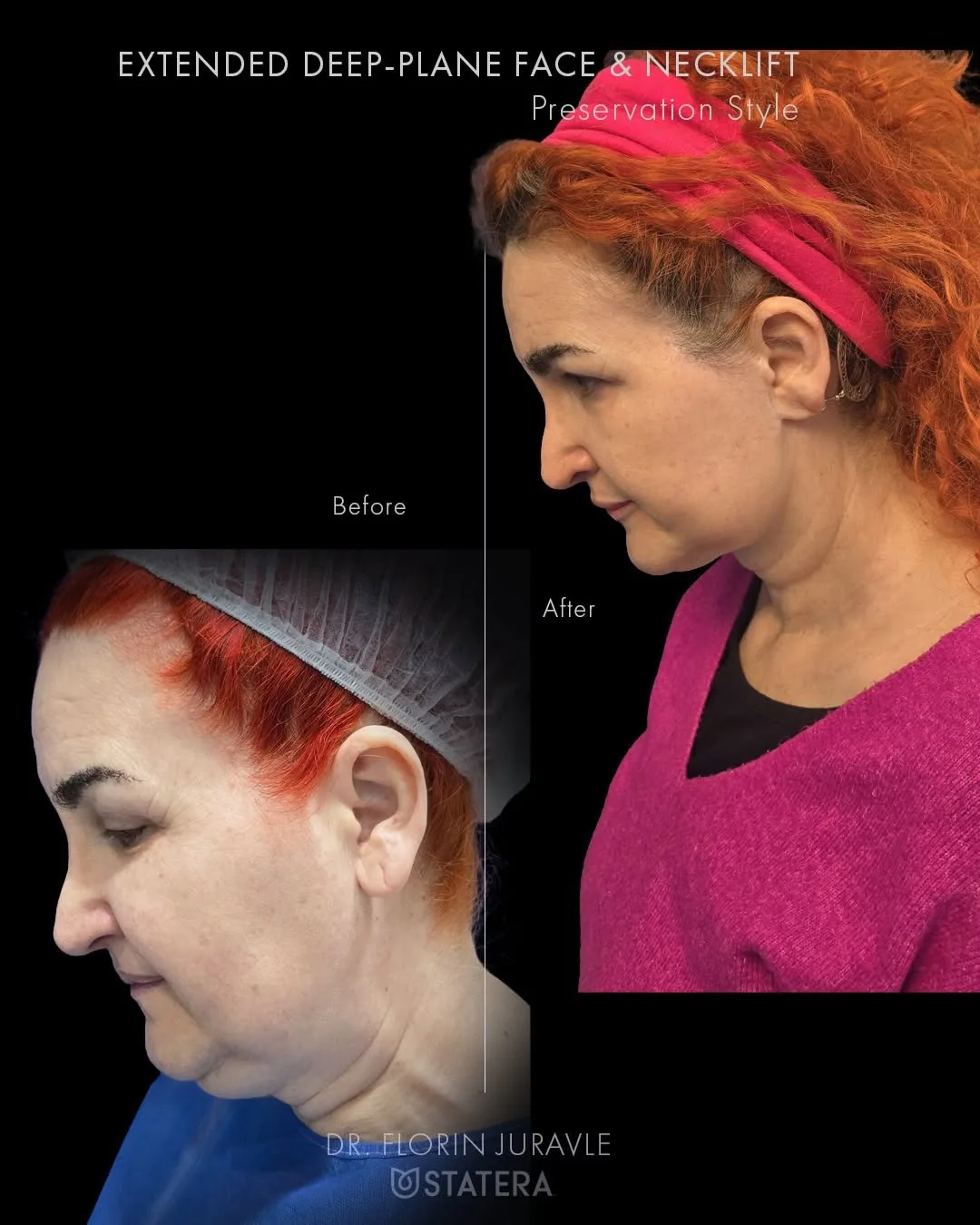 Before and after — Dr. Florin Juravle