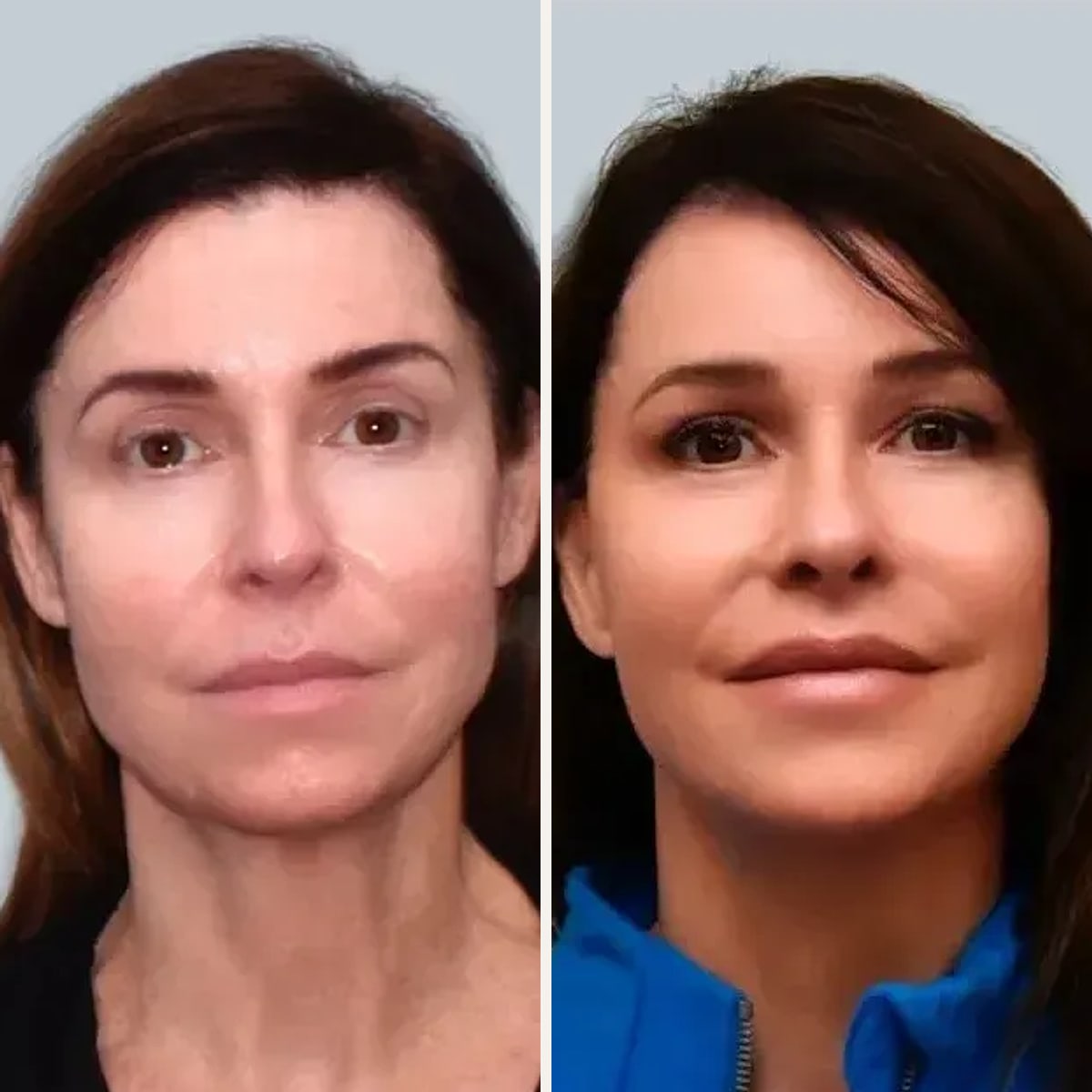До и после — Deep Plane Facelift от доктора Foad Nahai