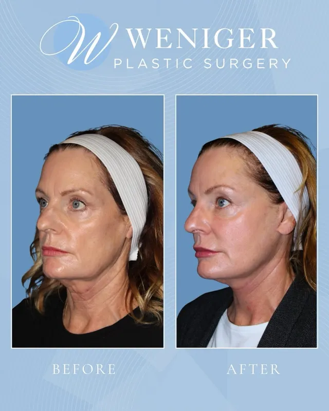 Before and after — Dr. Frederick Weniger