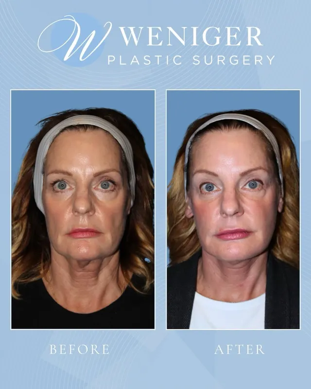 Before and after — Dr. Frederick Weniger