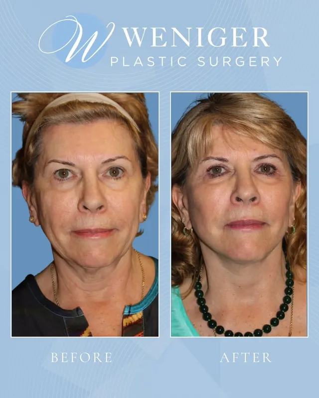 Before and after — Dr. Frederick Weniger