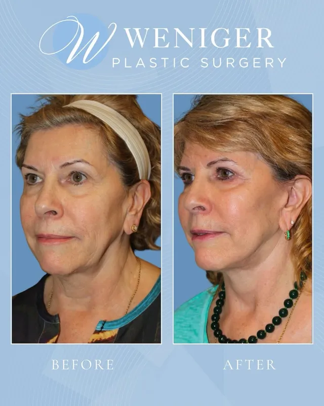 Before and after — Dr. Frederick Weniger