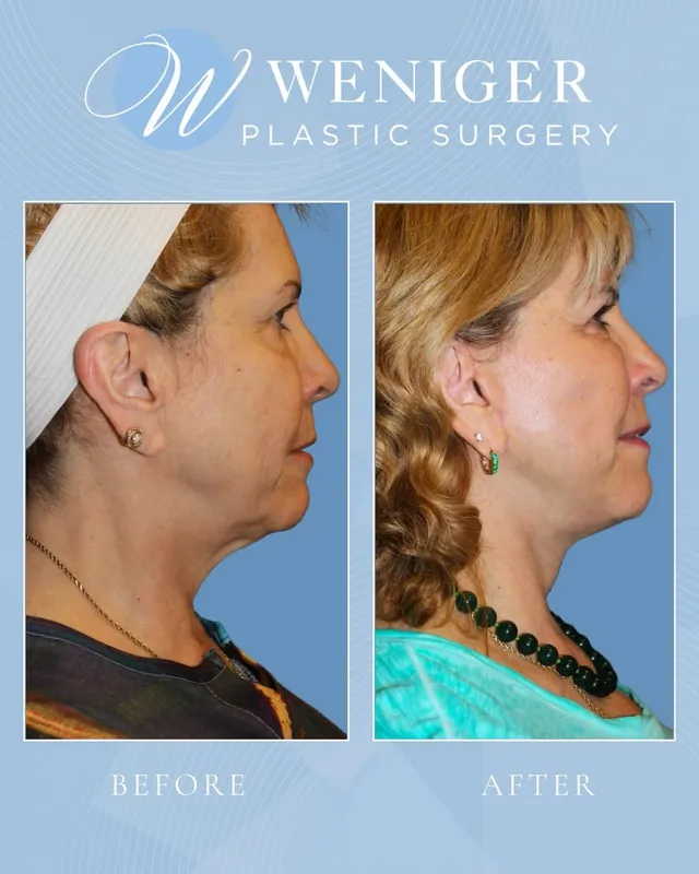 Before and after — Dr. Frederick Weniger