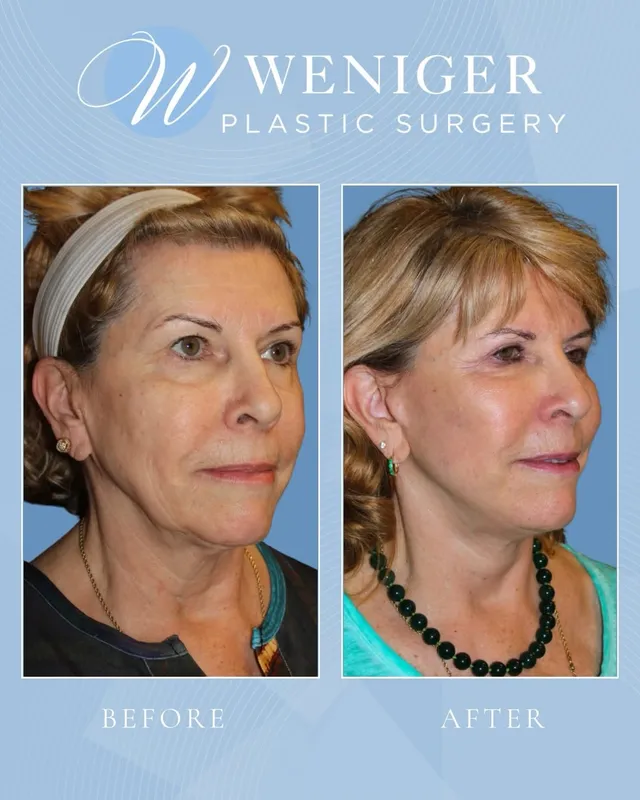 Before and after — Dr. Frederick Weniger