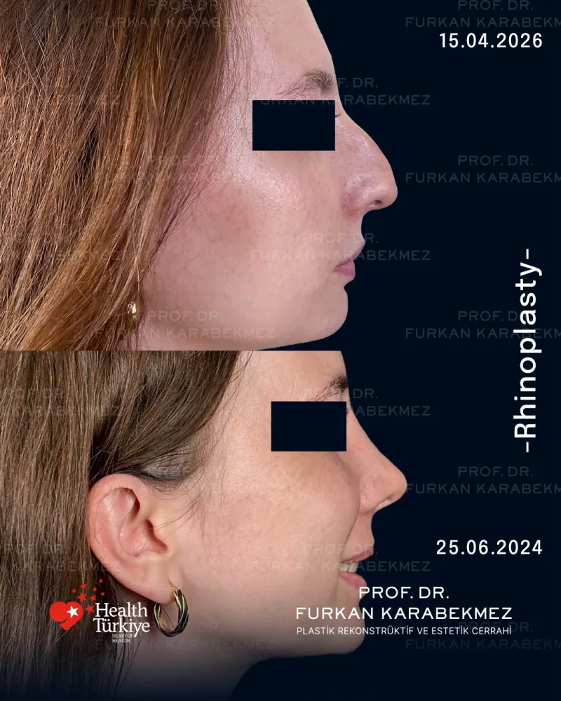 Before and after — Prof. Furkan Karabekmez