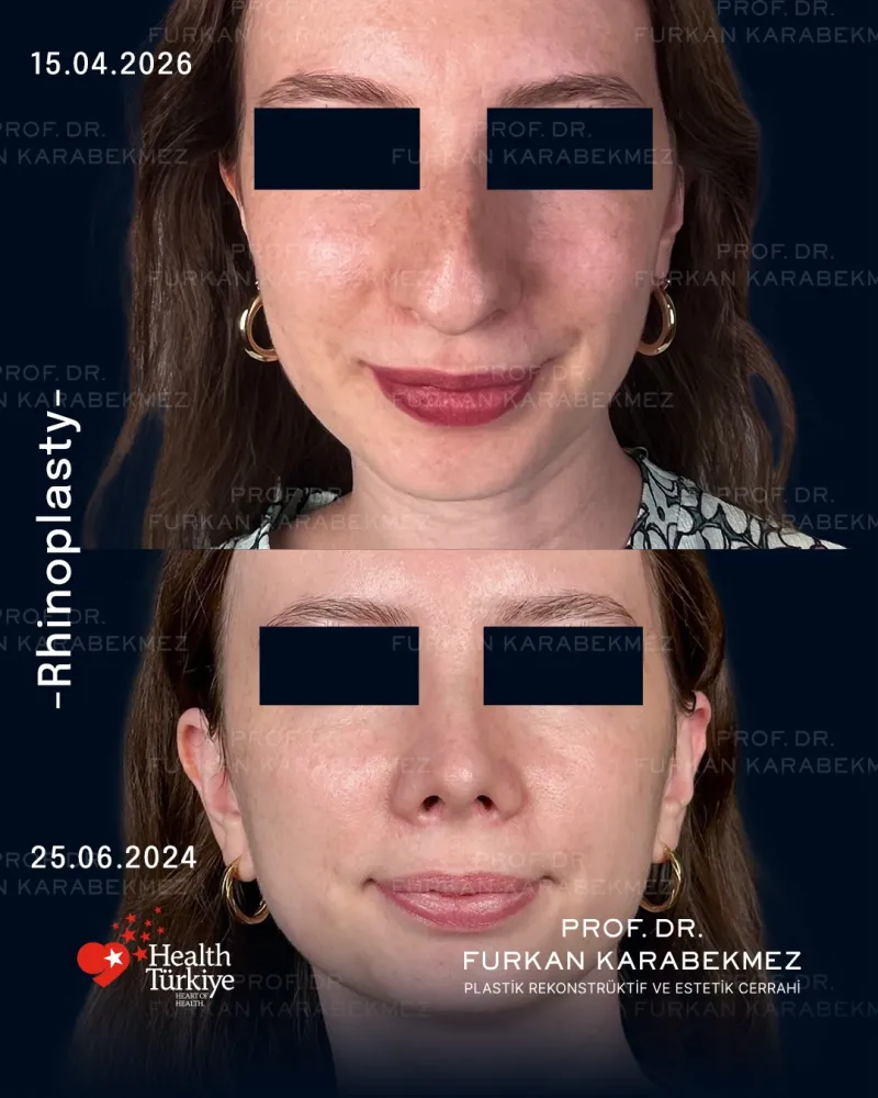 Before and after — Prof. Furkan Karabekmez