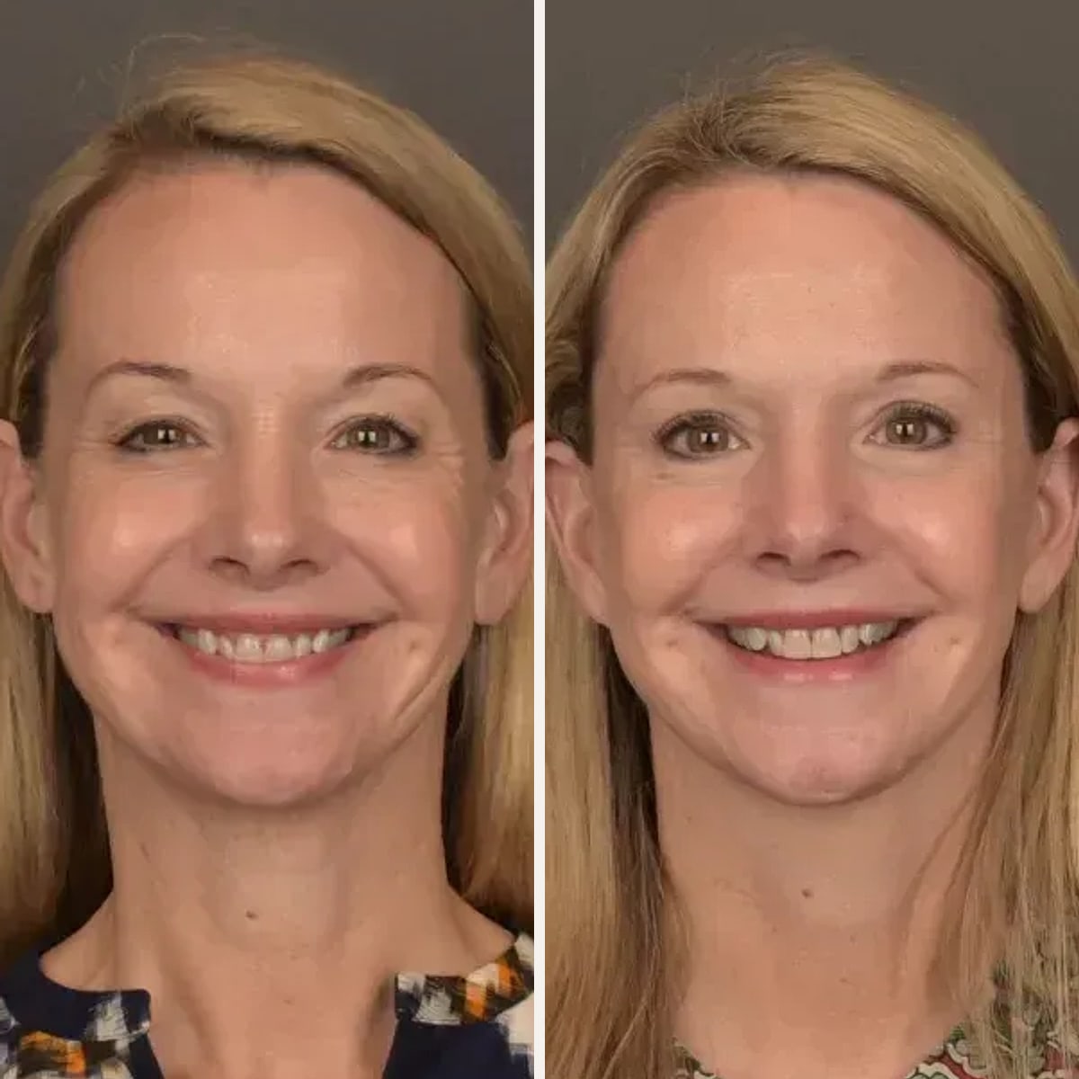 Before and after: Dr. Gabriele Miotto