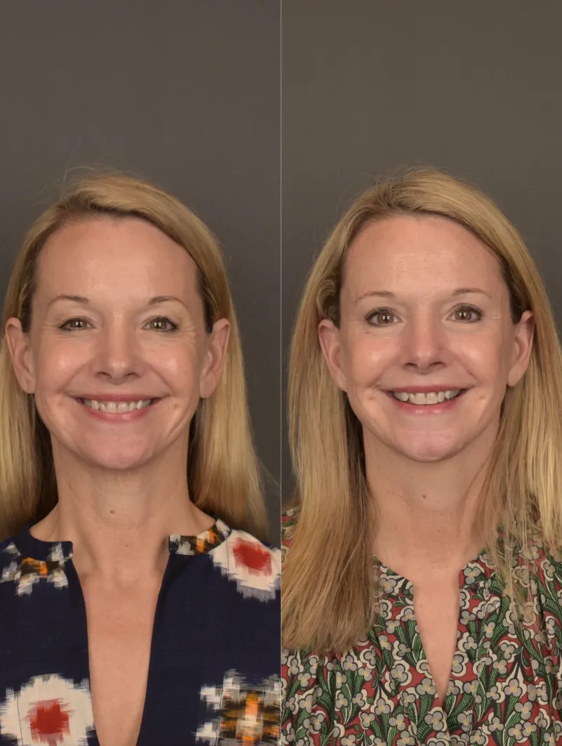Before and after — Dr. Gabriele Miotto