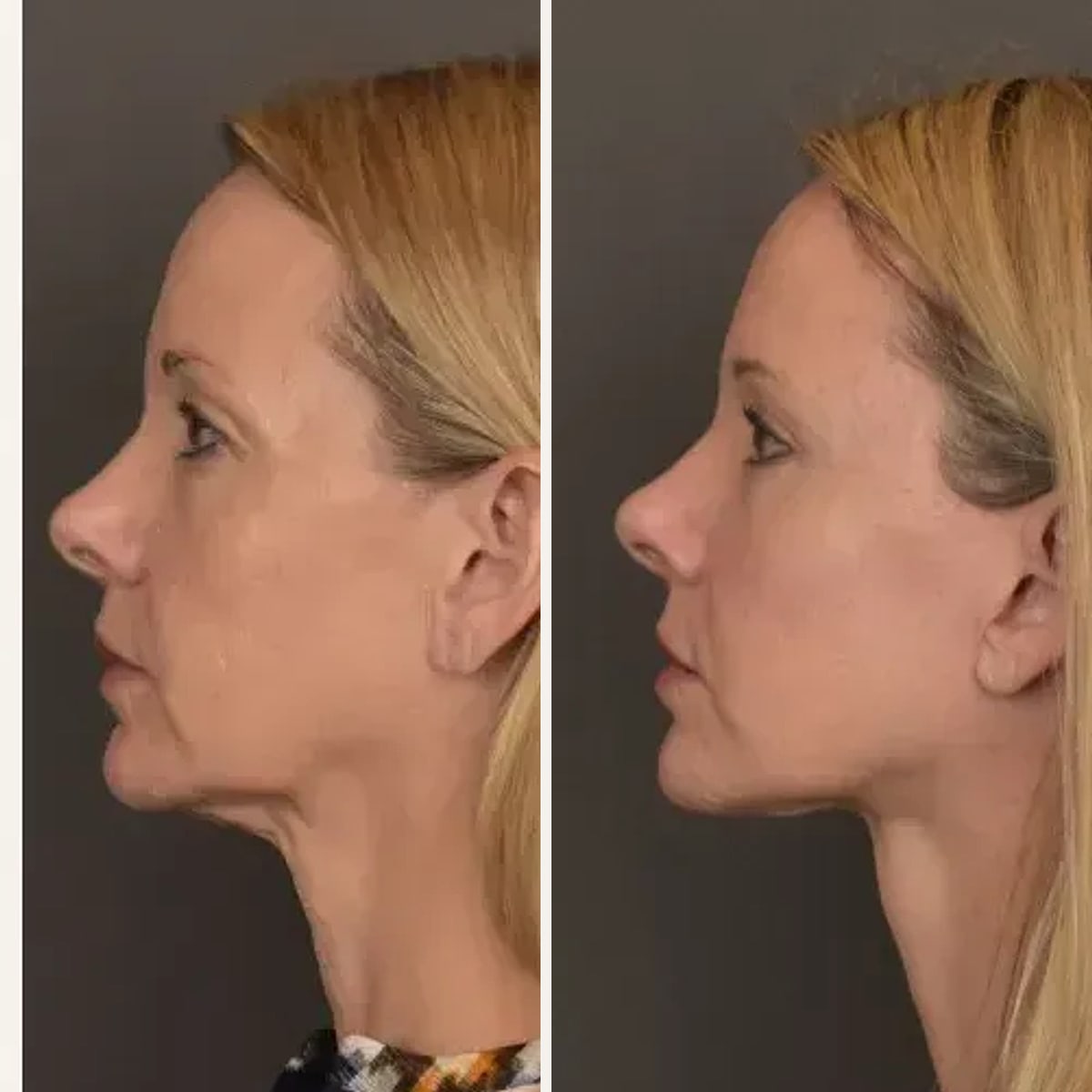 Before and after: Dr. Gabriele Miotto