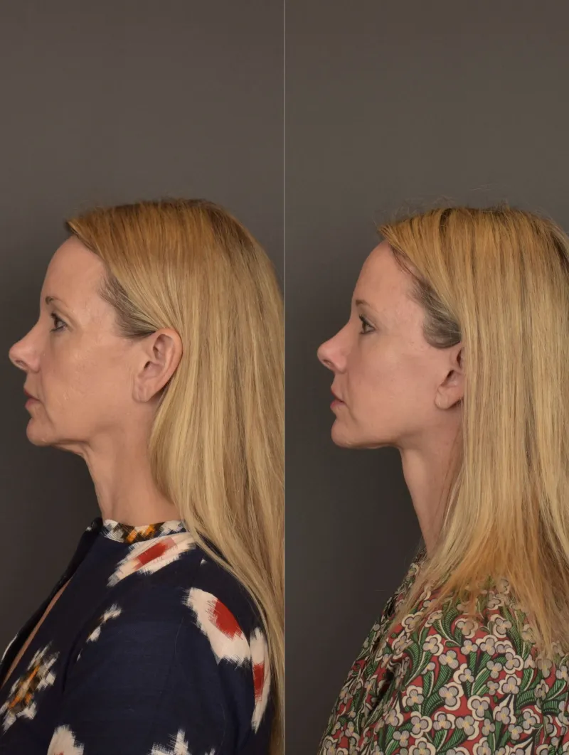 Before and after — Dr. Gabriele Miotto