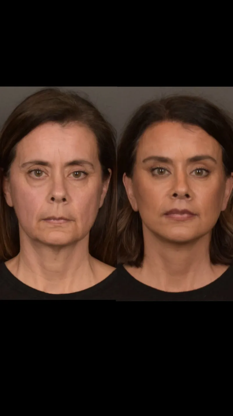 Before and after — Dr. Gabriele Miotto