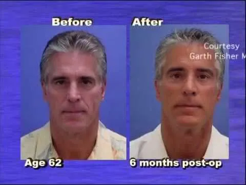 Before and after — Dr. Garth Fisher