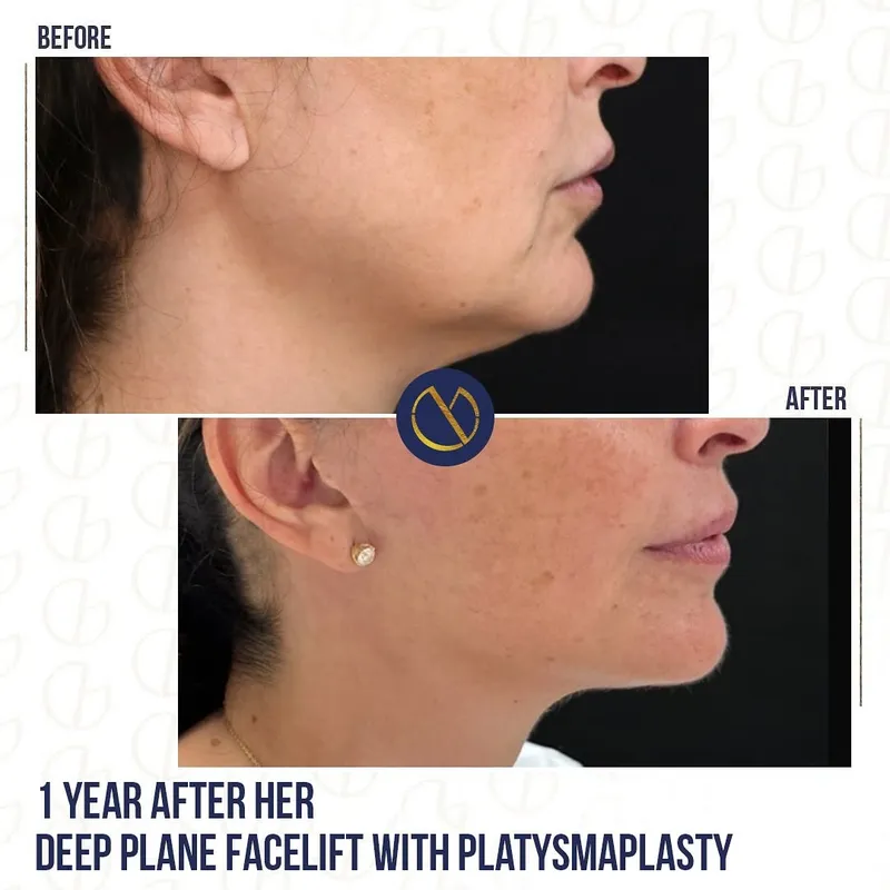 Before and after deep plane facelift, frontal view by Dr. Georges Ziade