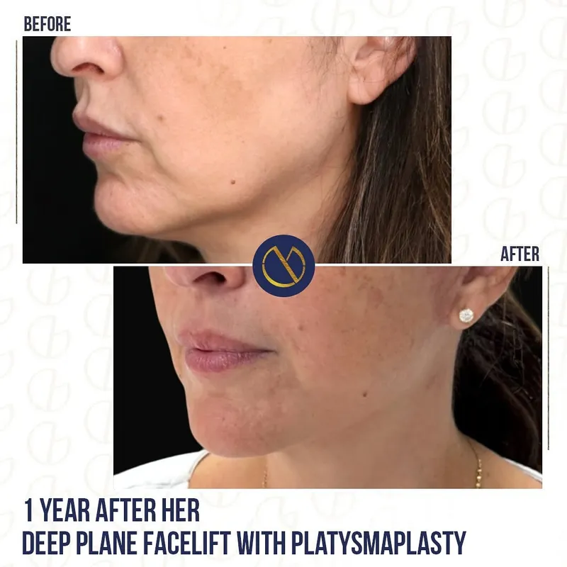 Before and after deep plane facelift, frontal view by Dr. Georges Ziade