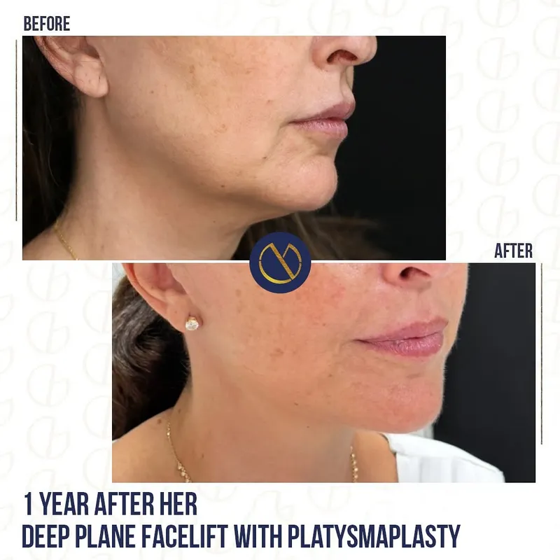 Before and after deep plane facelift, frontal view by Dr. Georges Ziade