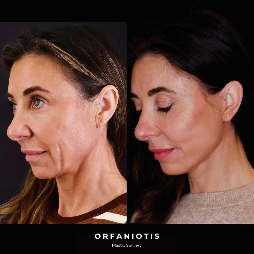 Before and after deep plane facelift — 53-year-old woman, right profile view, 7mo post-op by Dr. Georgios Orfaniotis