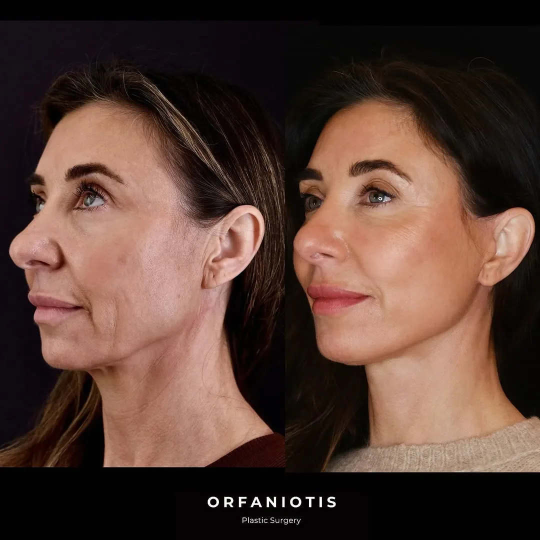 Before and after deep plane facelift — 48-year-old woman, left profile view, 6mo post-op by Dr. Georgios Orfaniotis