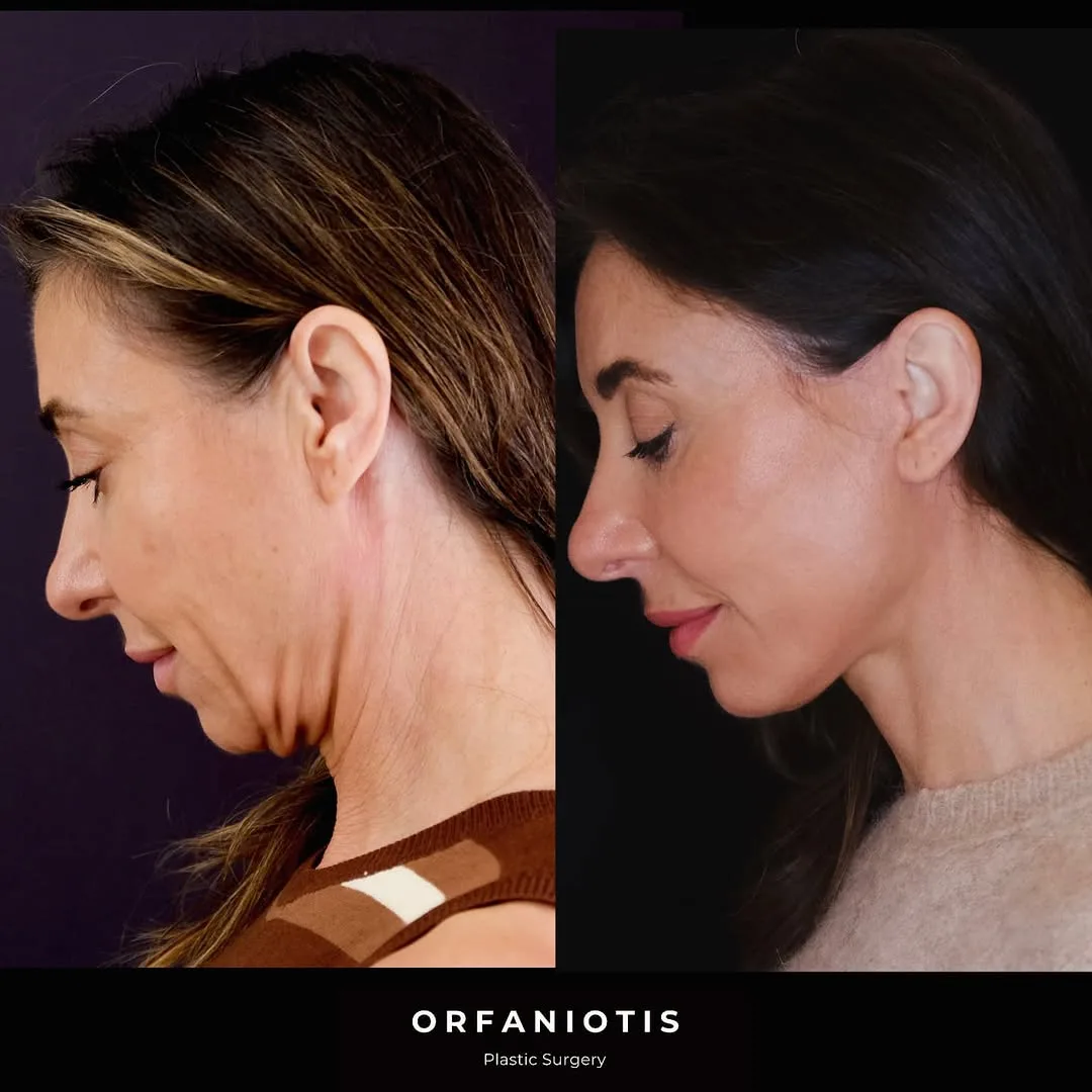 Before and after deep plane facelift — 45-year-old woman, left profile view, 9mo post-op by Dr. Georgios Orfaniotis