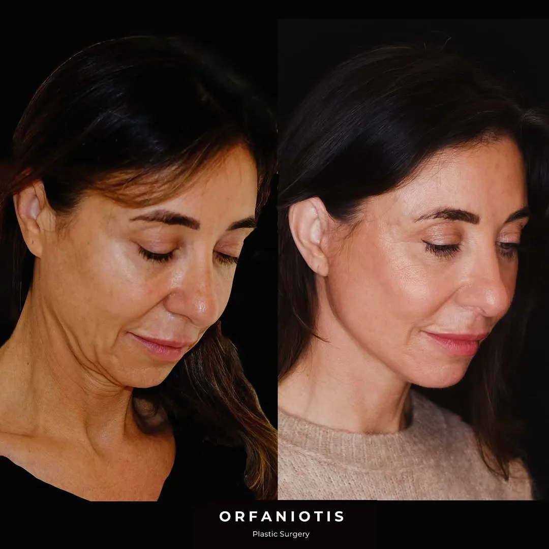 Before and after deep plane facelift — 48-year-old woman, oblique right view, 6mo post-op by Dr. Georgios Orfaniotis