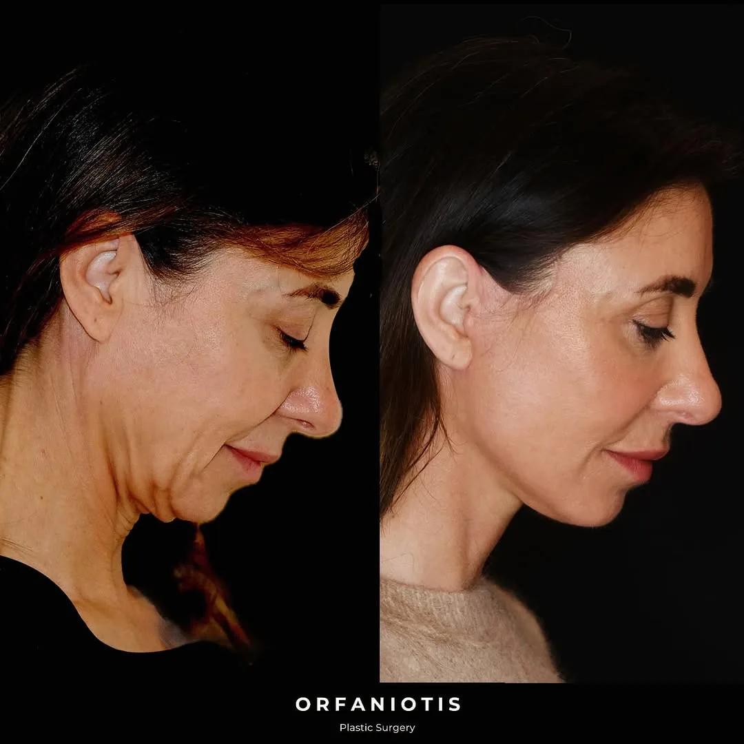 Before and after deep plane facelift — 48-year-old woman, right profile view, 6mo post-op by Dr. Georgios Orfaniotis