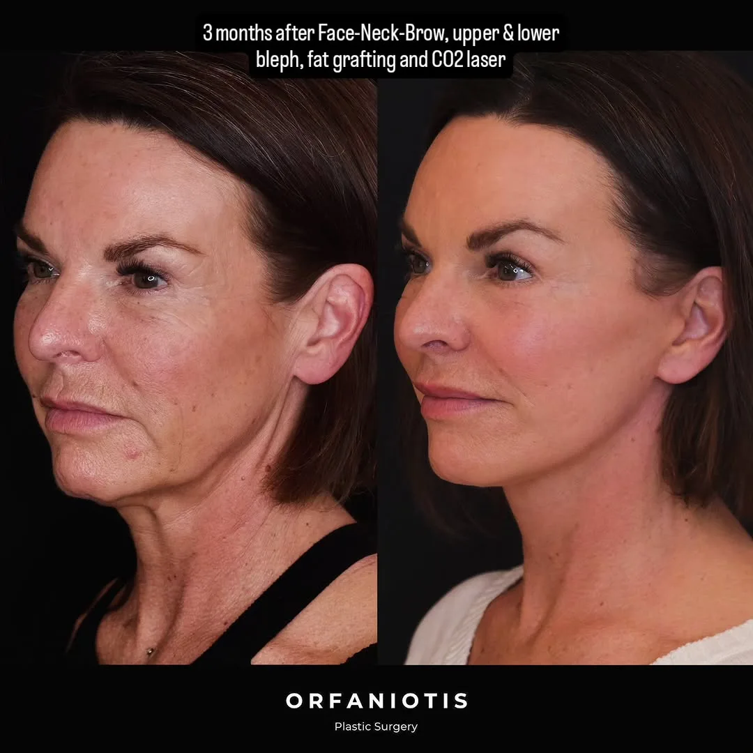 Before and after deep plane facelift — 53-year-old woman, left profile view, 3mo post-op by Dr. Georgios Orfaniotis