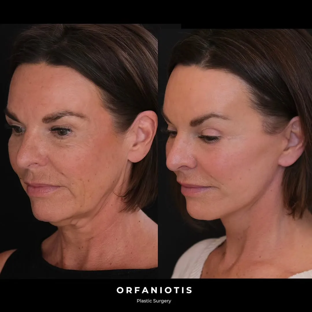 Before and after deep plane facelift — 52-year-old woman, left profile view, 6mo post-op by Dr. Georgios Orfaniotis
