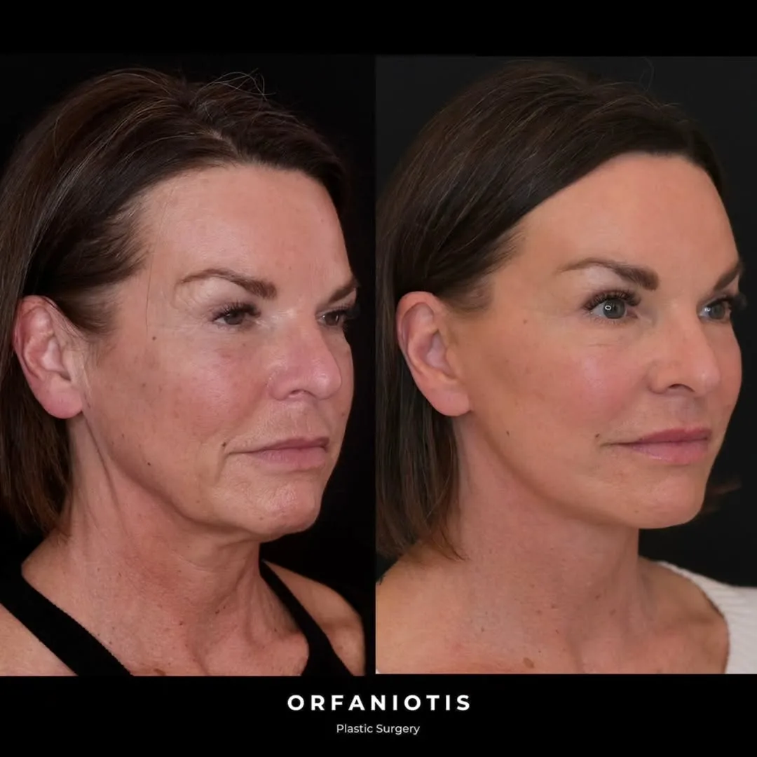 Before and after deep plane facelift — 52-year-old woman, oblique right view, 6mo post-op by Dr. Georgios Orfaniotis