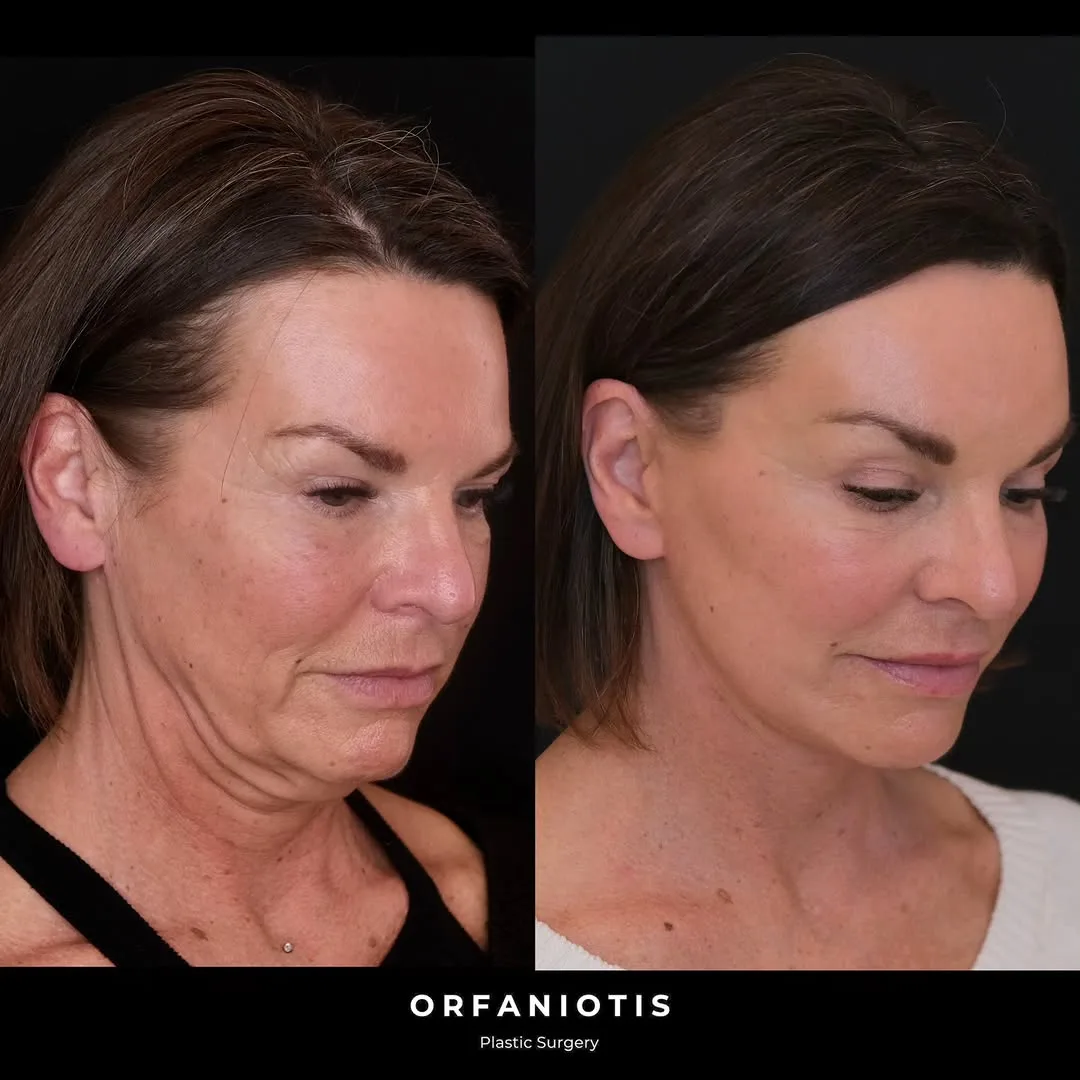 Before and after deep plane facelift — 52-year-old woman, oblique left view, 6mo post-op by Dr. Georgios Orfaniotis