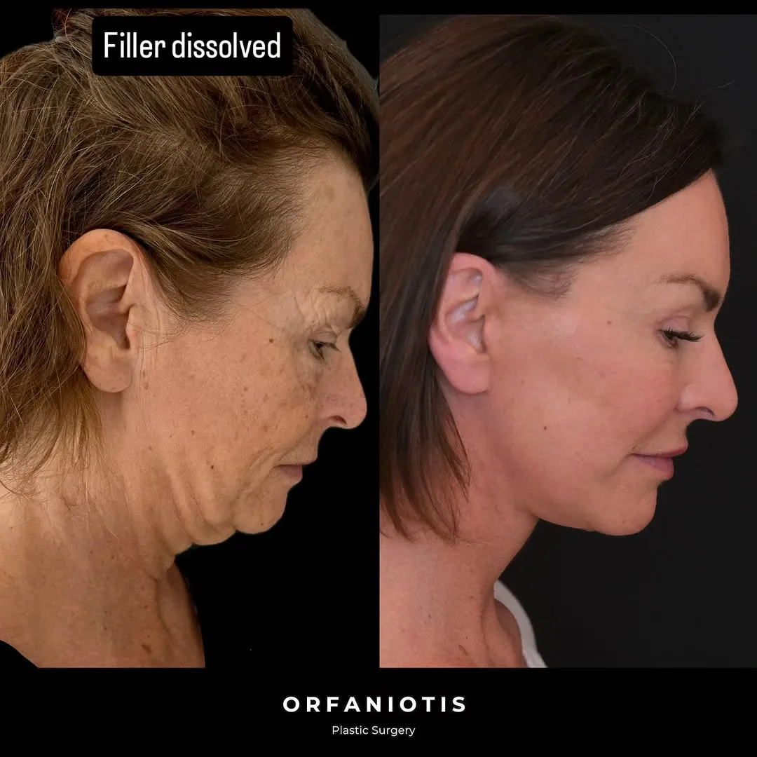 Before and after deep plane facelift — 58-year-old woman, right profile view, 8mo post-op by Dr. Georgios Orfaniotis