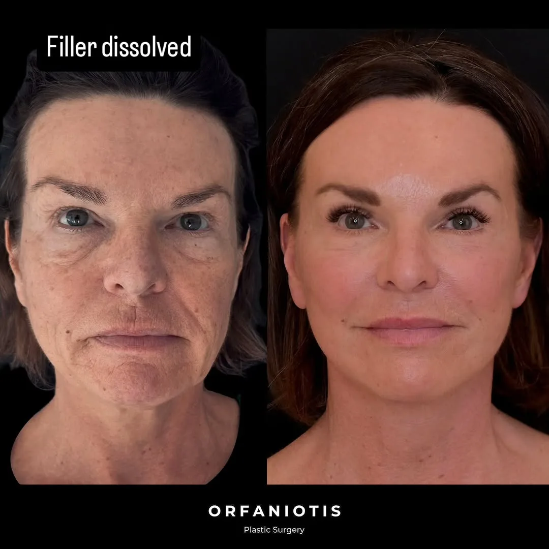 Before and after deep plane facelift — 55-year-old woman, frontal view, 7mo post-op by Dr. Georgios Orfaniotis