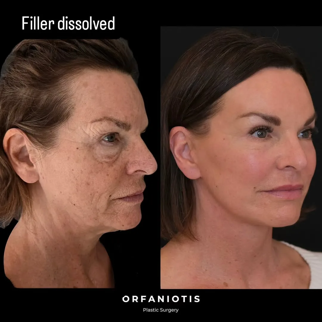Before and after deep plane facelift — 52-year-old woman, right profile view, 8mo post-op by Dr. Georgios Orfaniotis