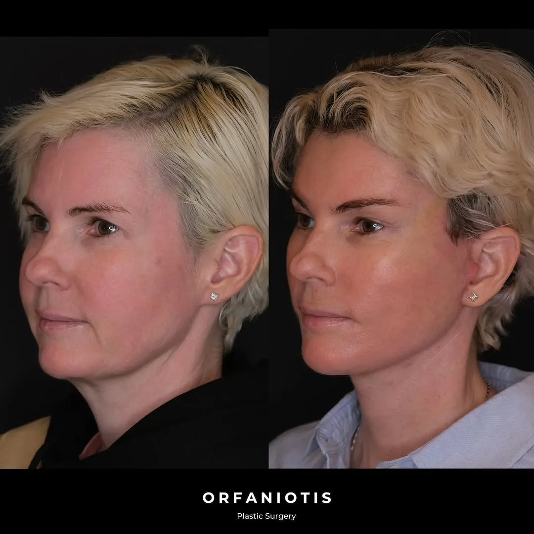Before and after deep plane facelift — 45-year-old woman, three-quarter view, 1mo post-op by Dr. Georgios Orfaniotis
