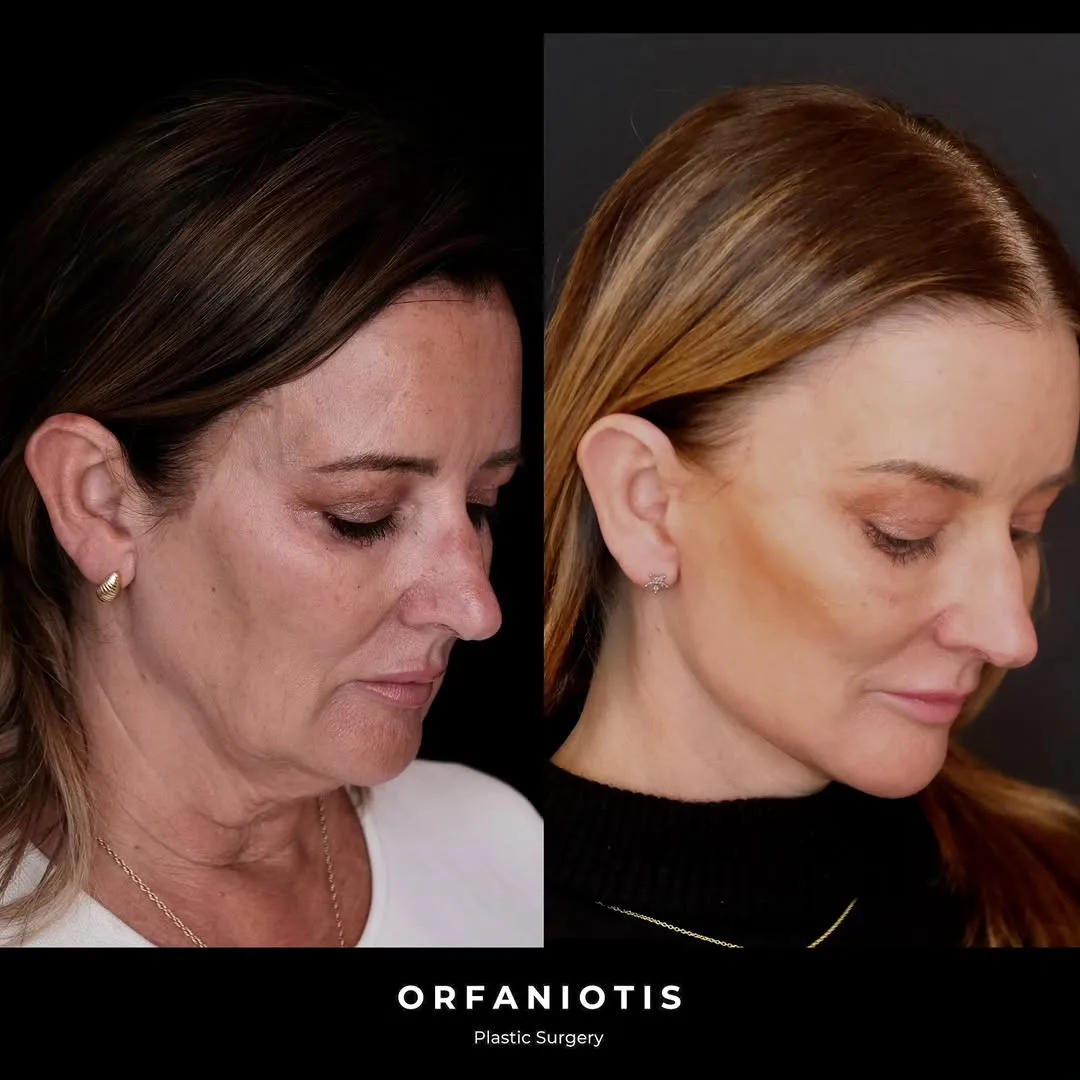 Before and after deep plane facelift — 62-year-old woman, right profile view, 7mo post-op by Dr. Georgios Orfaniotis