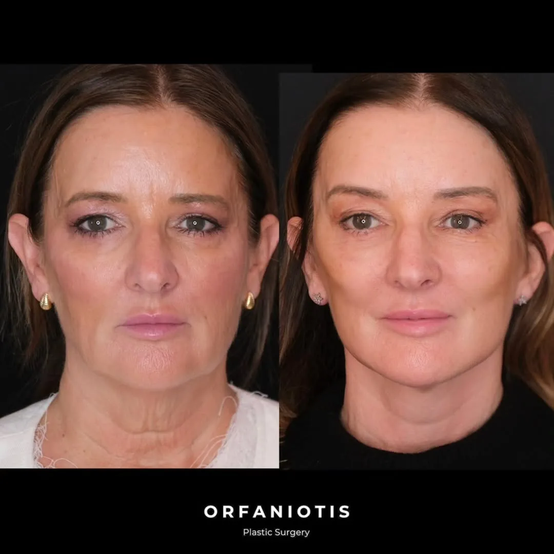 Before and after deep plane facelift — 62-year-old woman, frontal view, 7mo post-op by Dr. Georgios Orfaniotis