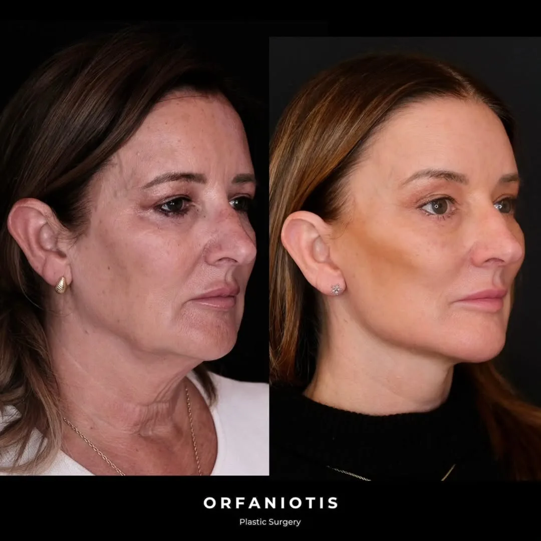 Before and after deep plane facelift — 62-year-old woman, right profile view, 6mo post-op by Dr. Georgios Orfaniotis