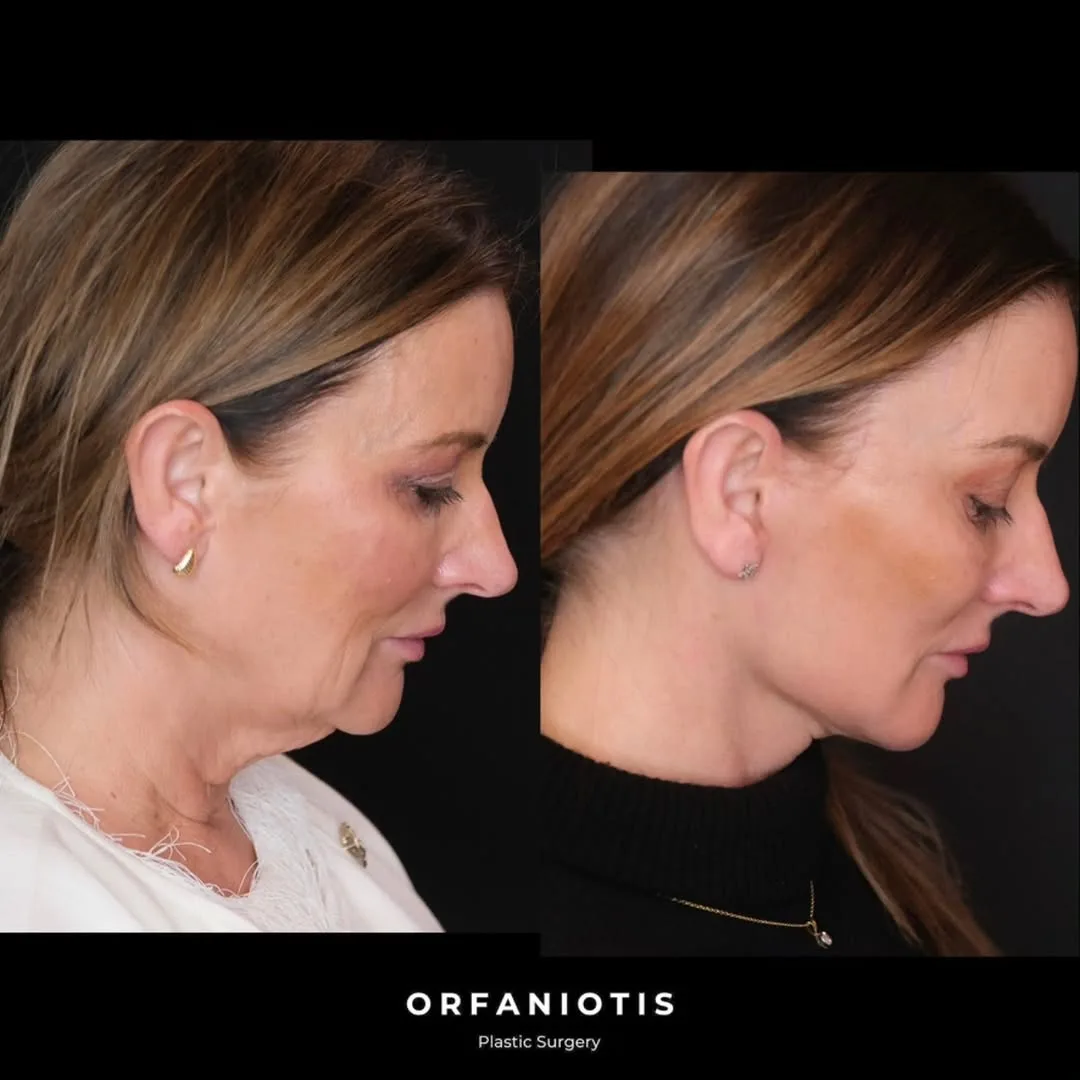 Before and after deep plane facelift — 62-year-old woman, left profile view, 8mo post-op by Dr. Georgios Orfaniotis