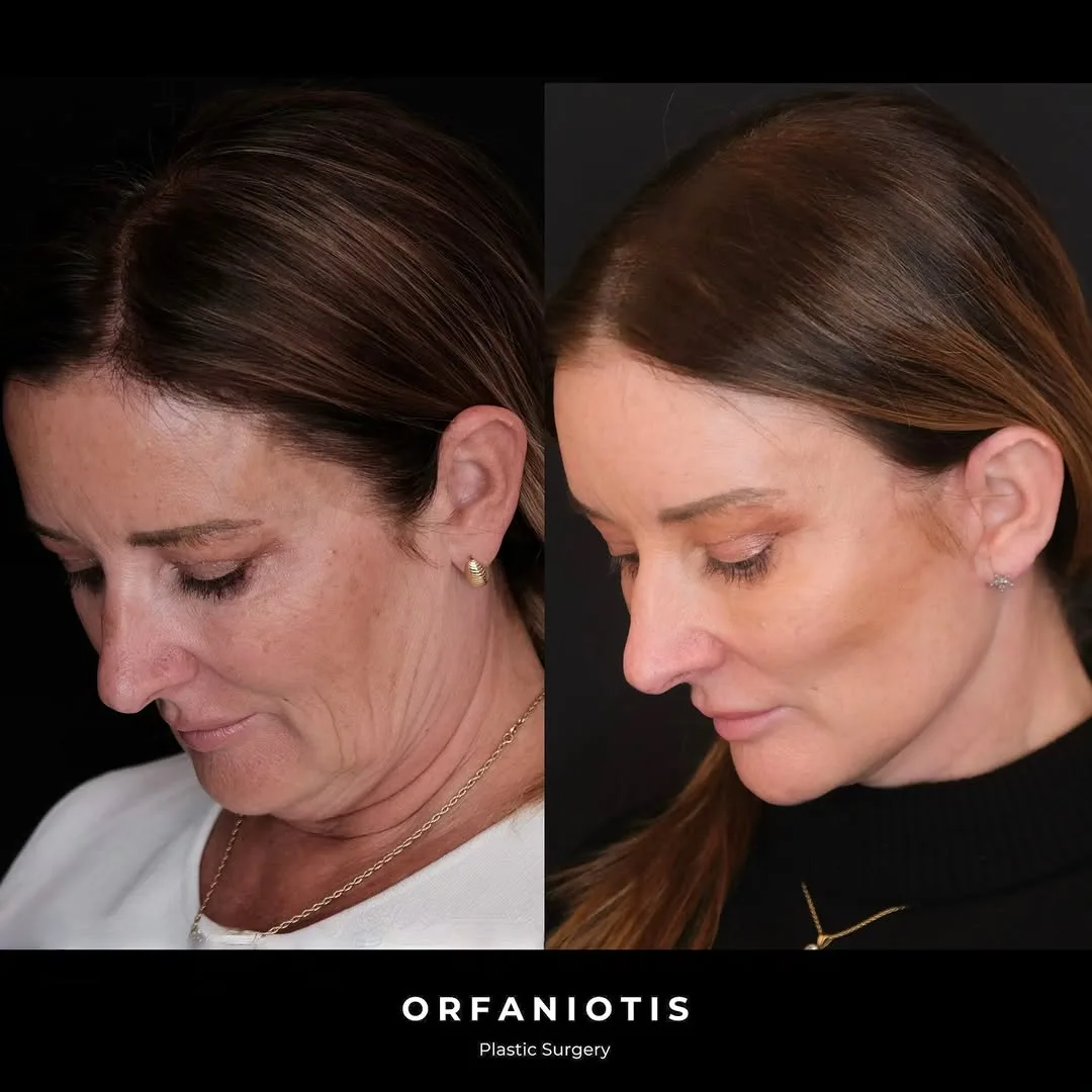Before and after deep plane facelift — 62-year-old woman, right profile view, 9mo post-op by Dr. Georgios Orfaniotis