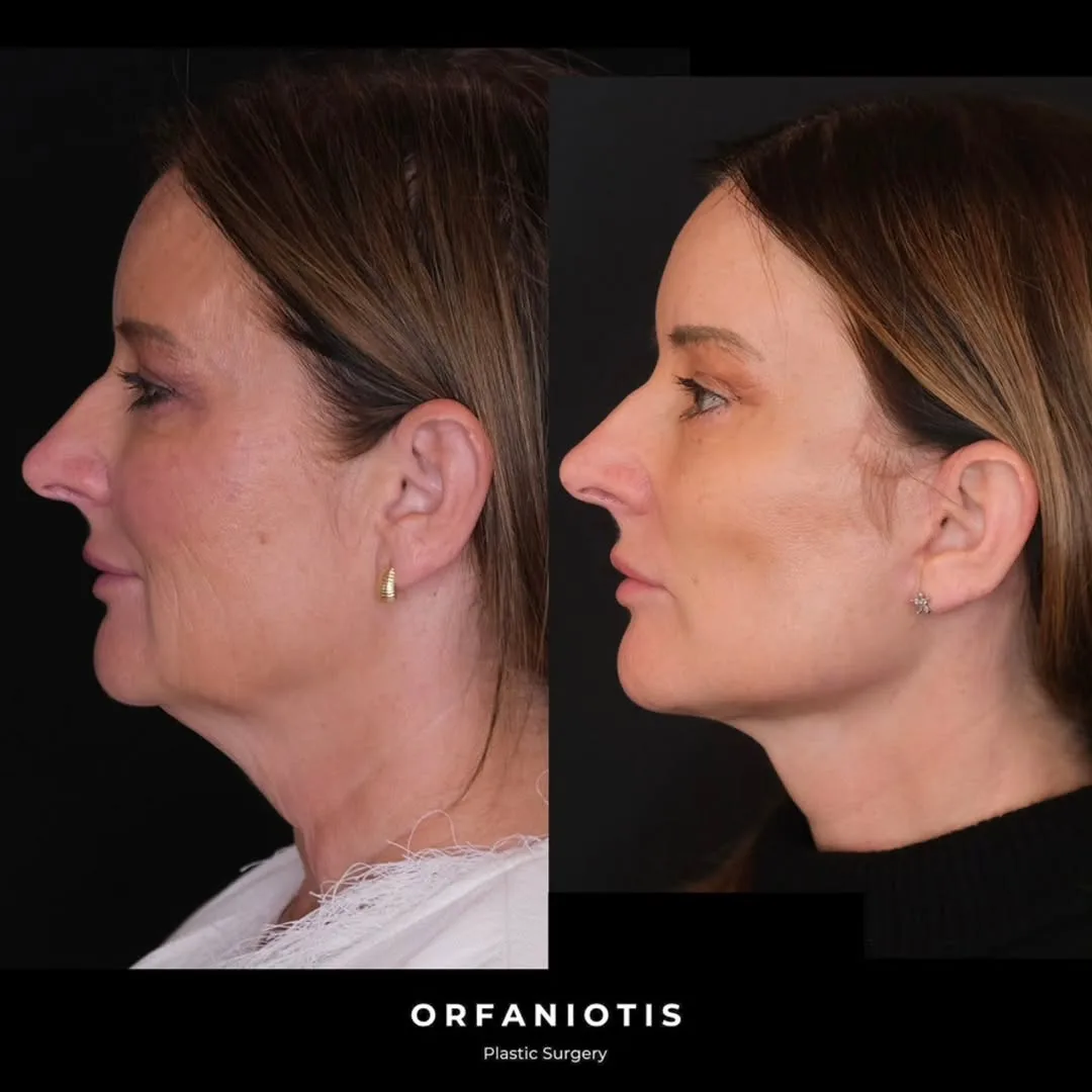 Before and after deep plane facelift — 62-year-old woman, left profile view, 7mo post-op by Dr. Georgios Orfaniotis