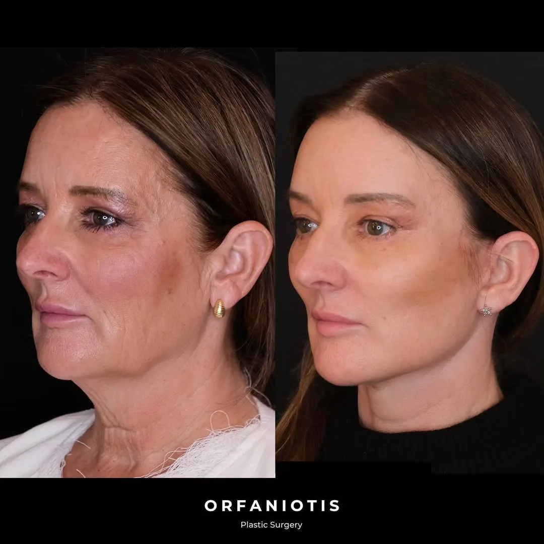 Before and after deep plane facelift — 62-year-old woman, left profile view, 6mo post-op by Dr. Georgios Orfaniotis