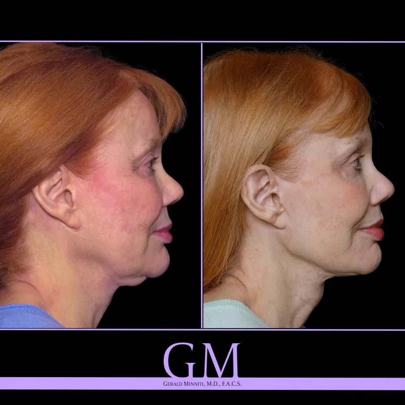 Before and after — Dr. Gerald Minniti
