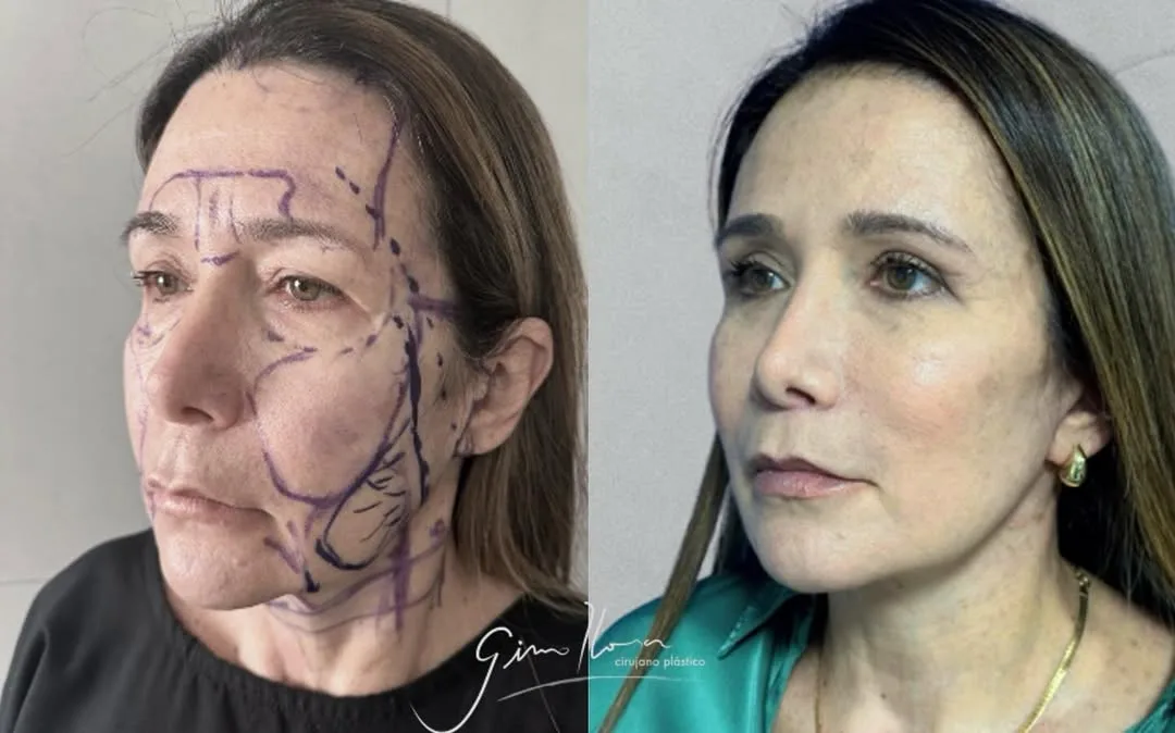 Before and after — Dr. Gino Llosa