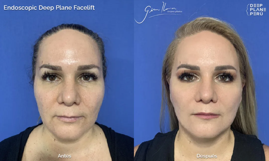 Before and after — Dr. Gino Llosa