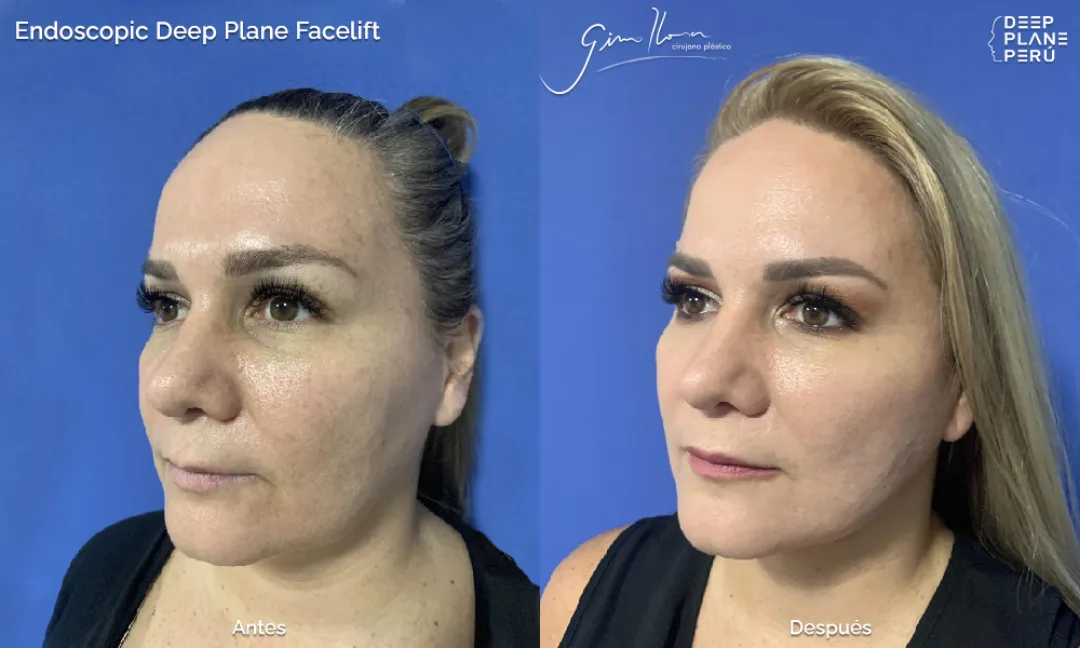 Before and after — Dr. Gino Llosa