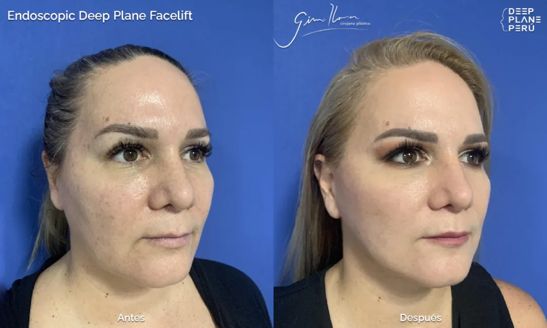 Before and after — Dr. Gino Llosa