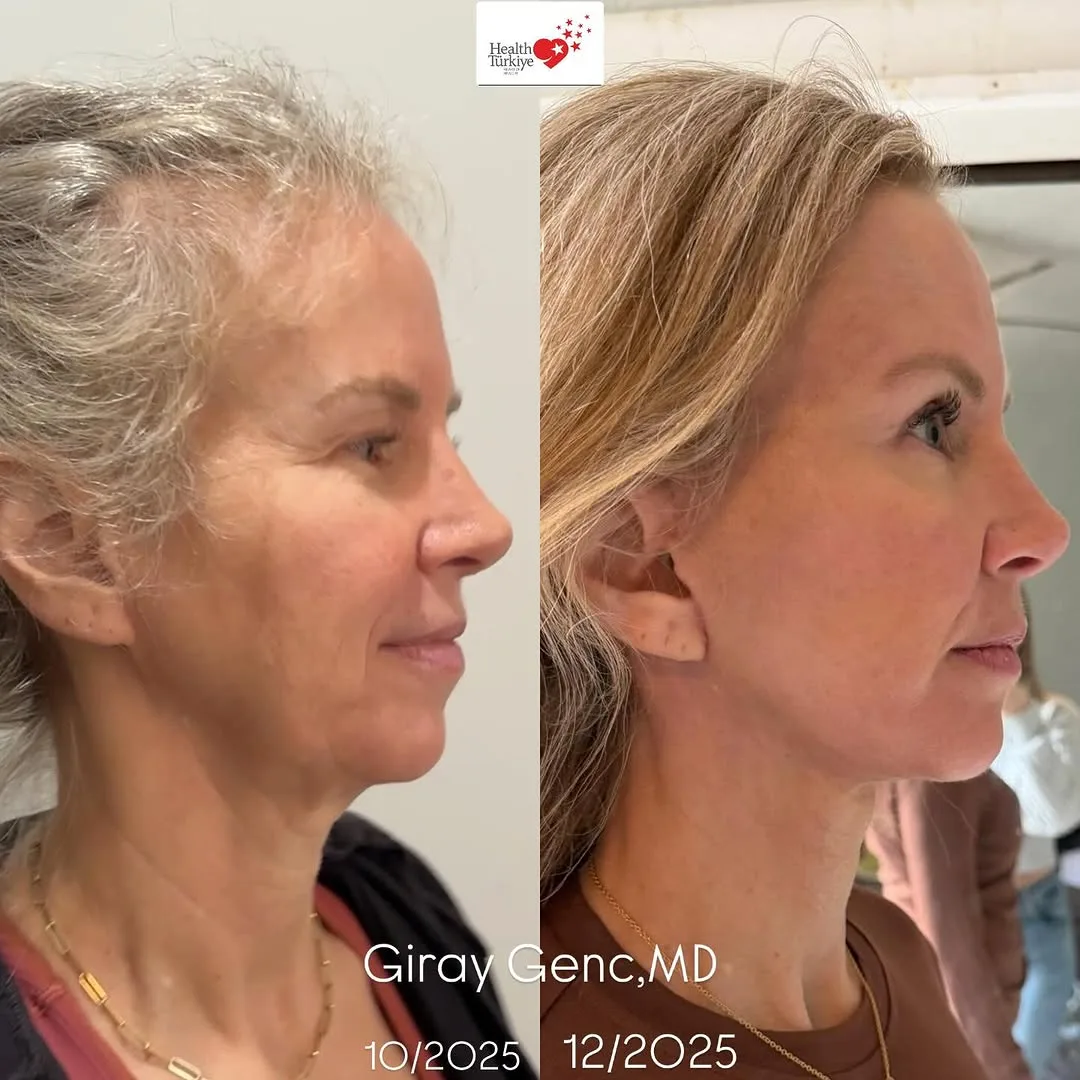 Before and after deep plane facelift — 58-year-old woman, right profile view, 2mo post-op by Dr. Giray Genç