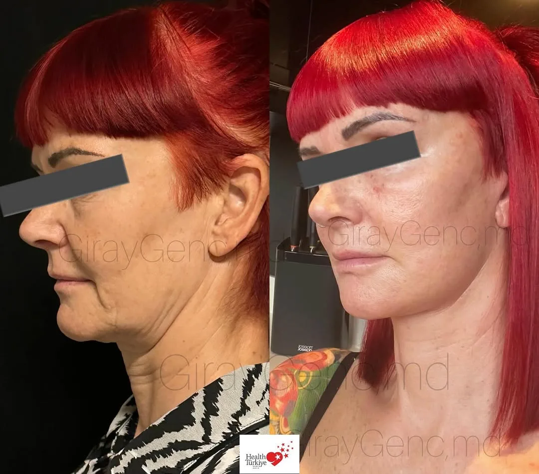 Before and after deep plane facelift — 55-year-old woman, left profile view, 6mo post-op by Dr. Giray Genç