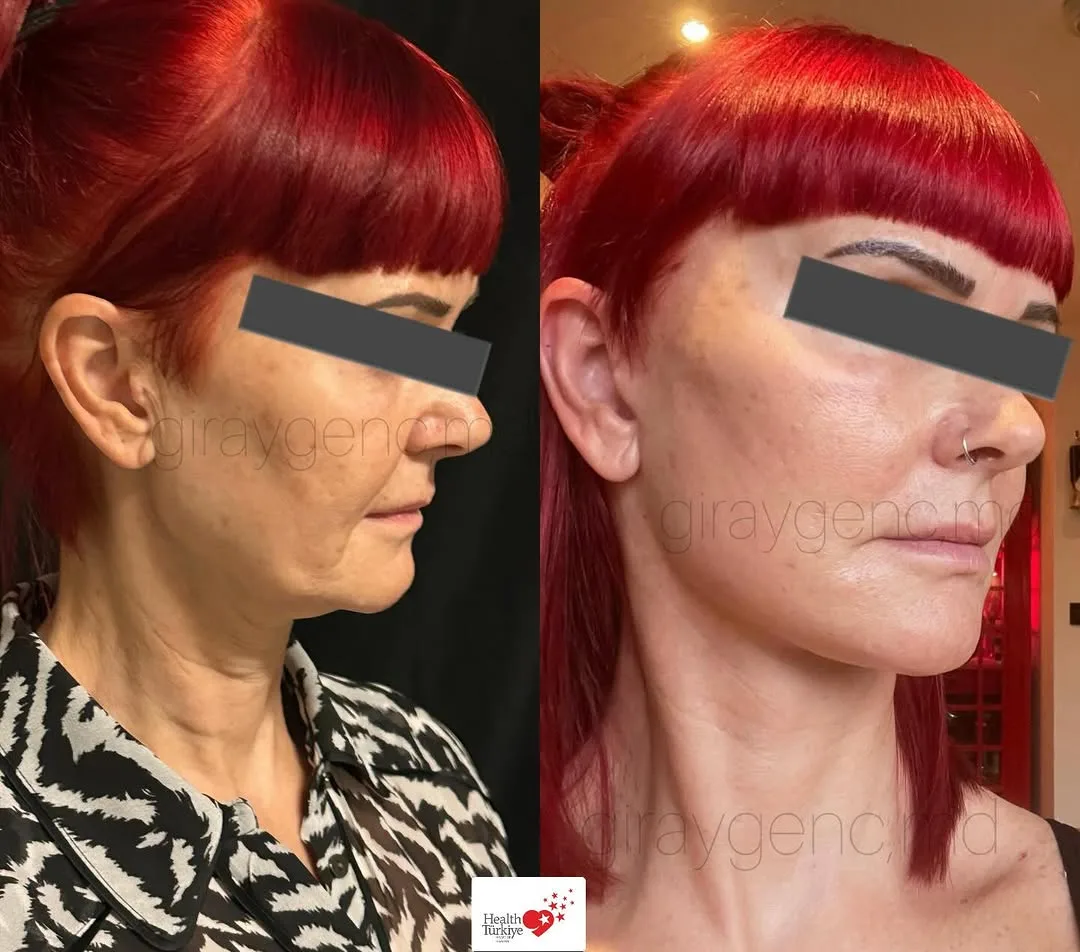 Before and after deep plane facelift — 45-year-old woman, left profile view, 6mo post-op by Dr. Giray Genç
