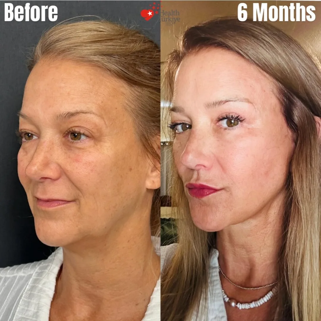 Before and after deep plane facelift — 48-year-old woman, oblique right view, 6mo post-op by Dr. Giray Genç