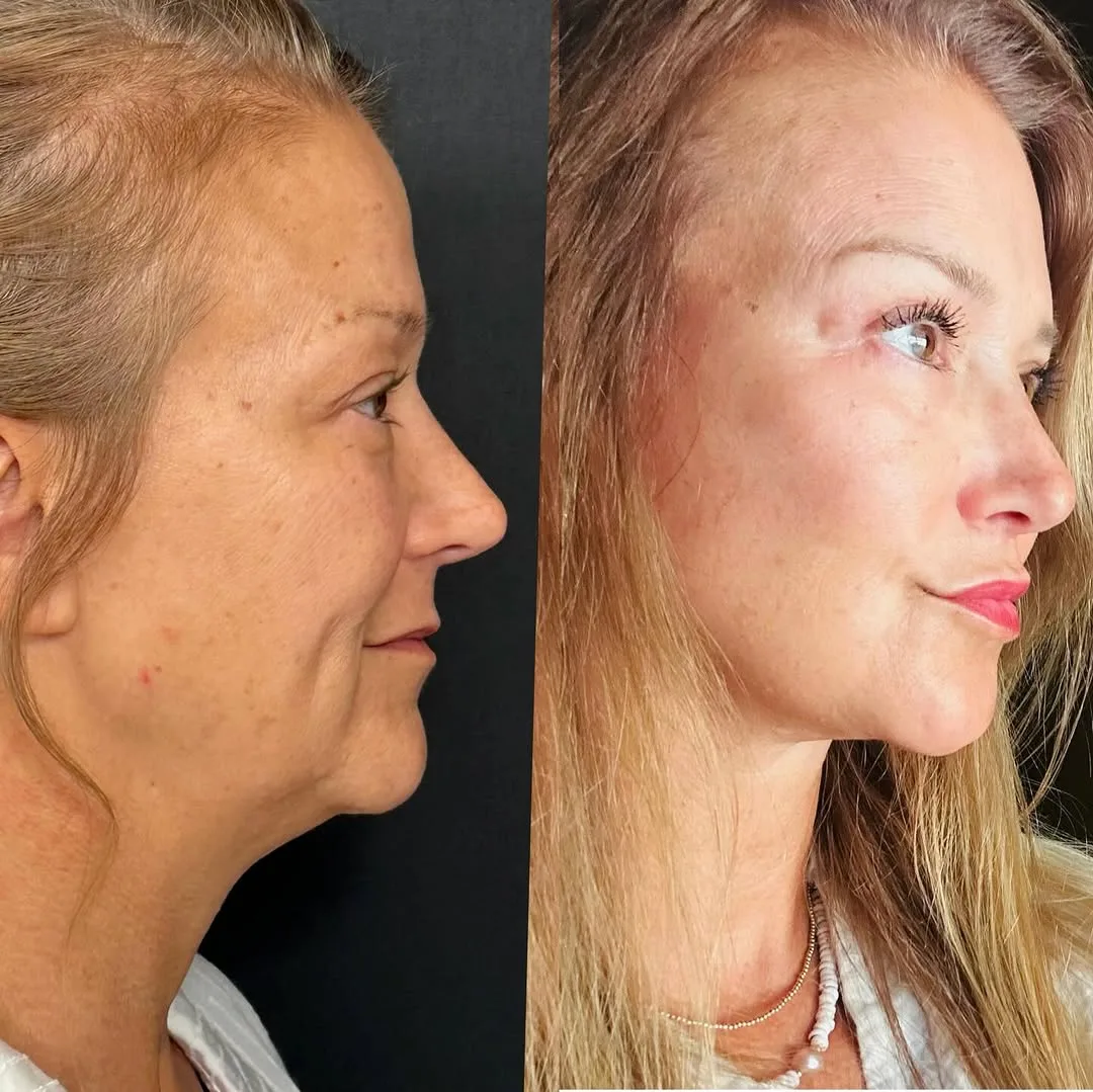 Before and after deep plane facelift — 55-year-old woman, right profile view, 6mo post-op by Dr. Giray Genç