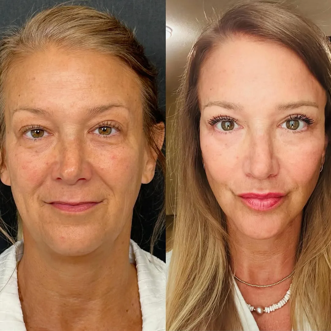 Before and after deep plane facelift — 52-year-old woman, oblique right view, 6mo post-op by Dr. Giray Genç